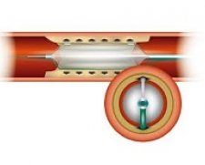 Orbus Neich Scoreflex Scoring Balloon | Used in Angioplasty, CTO Recanalisation  | Which Medical Device
